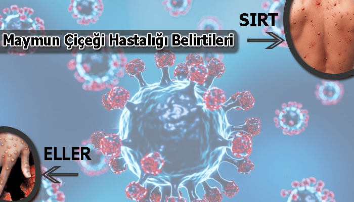 Maymun Çiçeği Hastalığı Belirtileri